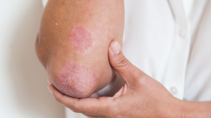 El Centenario habilita consultas para detectar la psoriasis