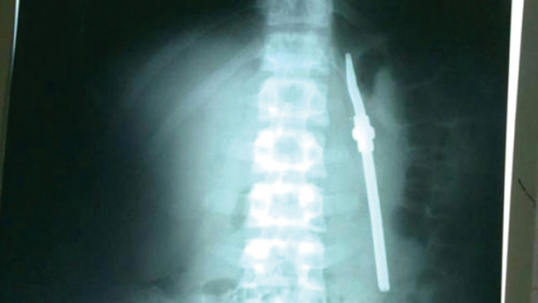 La radiografía no deja lugar a dudas sobre el objeto que tragó el preso