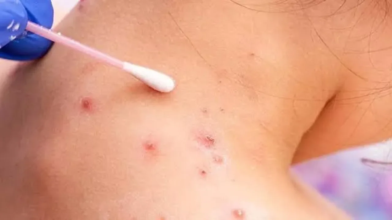 Salud informa la situación epidemiológica ante el alerta por viruela símica
